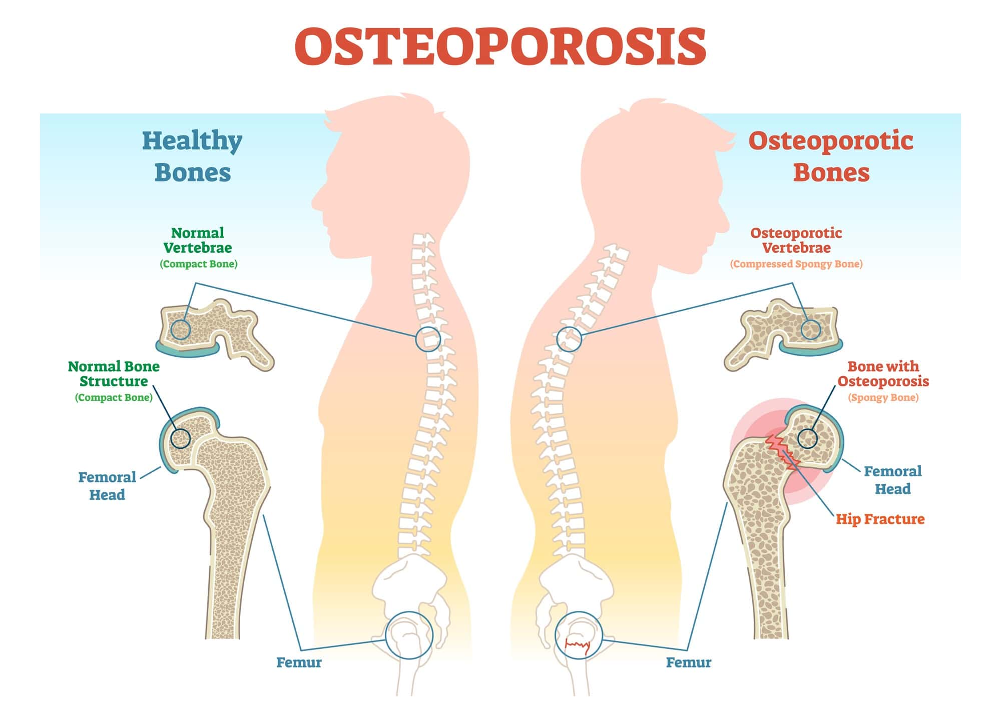 Senior person doing weight-bearing exercises to strengthen bones