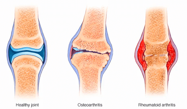 Physiotherapist demonstrating an exercise for knee arthritis