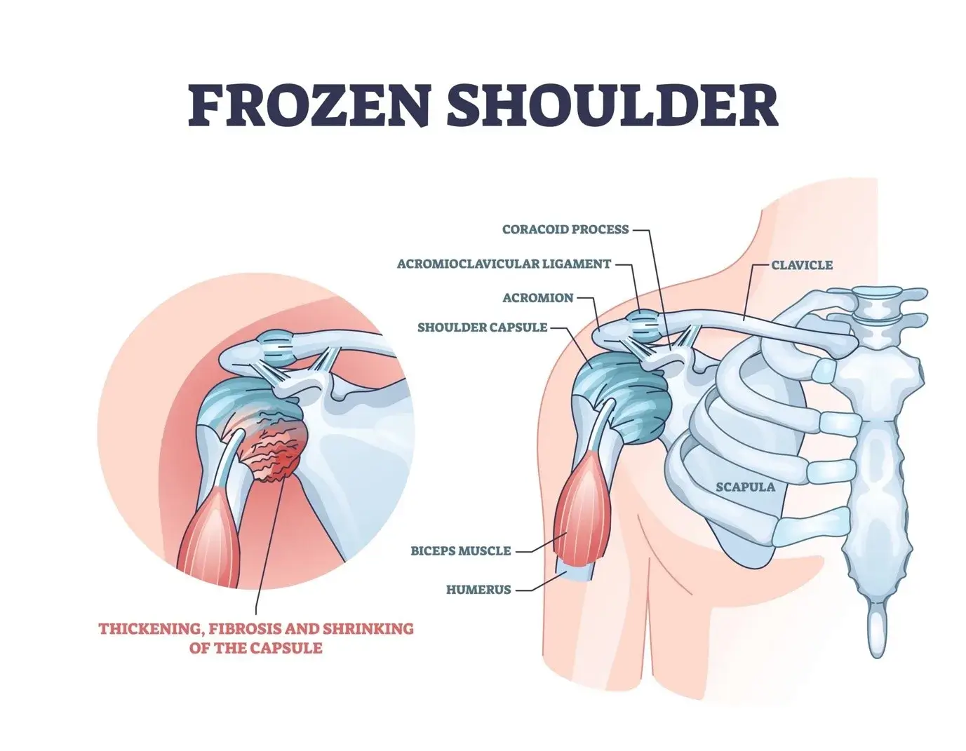 Person struggling to lift arm due to shoulder pain