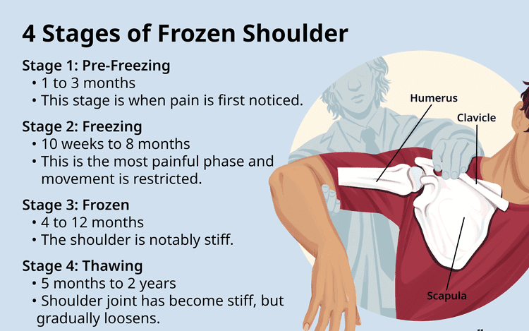 Diagram showing a healthy shoulder joint versus a frozen shoulder joint capsule