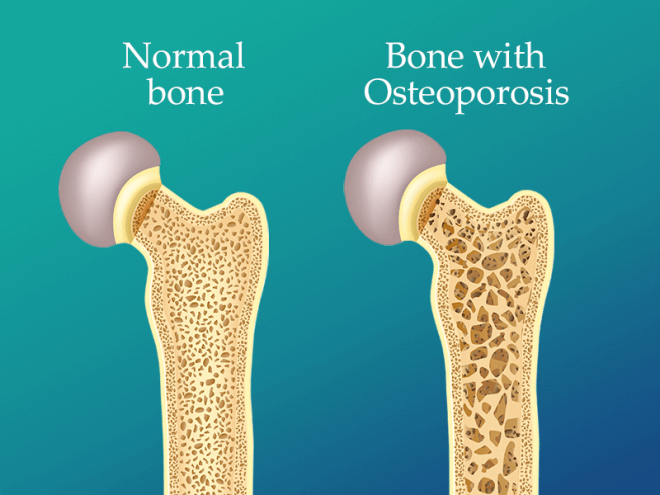 Senior person doing weight-bearing exercises to strengthen bones