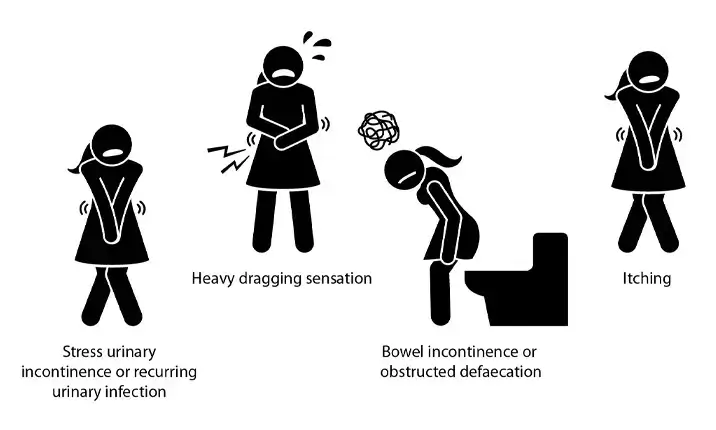 Illustrations depicting common pelvic floor dysfunctions