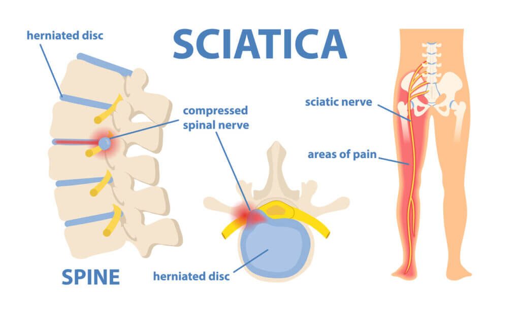 Person experiencing radiating leg pain from sciatica
