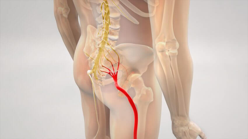 Diagram illustrating the sciatic nerve pathway and common compression points