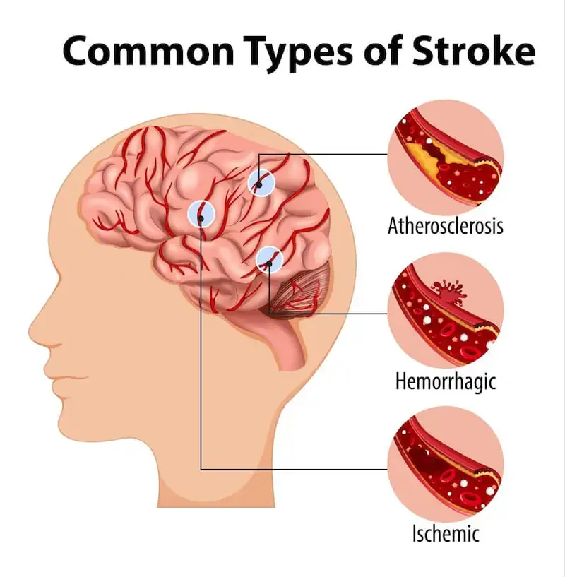 Diagram showing areas of the brain affected by stroke and corresponding body parts