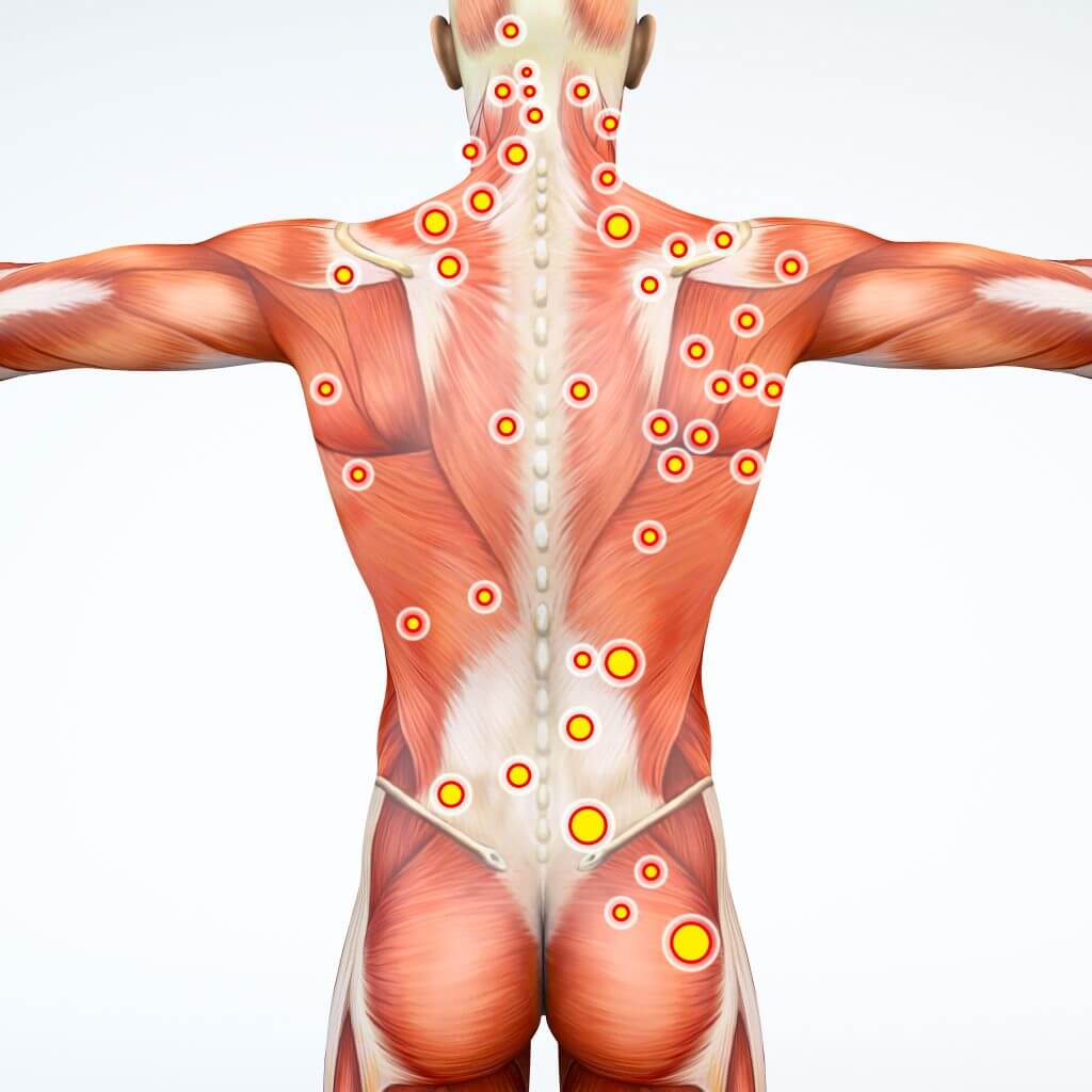 Diagram showing a myofascial trigger point in a muscle